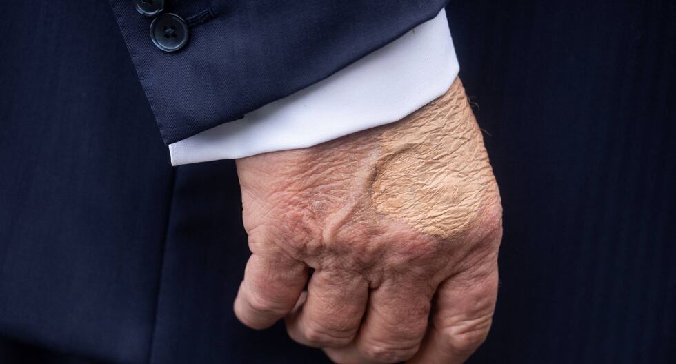 Donald Trump | Lo que dicen las manos y las piernas de Trump sobre su salud: ¿pueden ser una limitación para su trabajo? | Estados Unidos | Problemas de salud | Insuficiencia venosa crónica | MUNDO

 – El diario andino