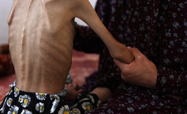 Guerra Israel – Hamás en Gaza: Franja de Gaza Registro OTRAS SEIS MUERTES RELACONADAS CON EL HAMBRE Y SUMA AL MENOS 175 DECESOS | Palestina | Unrwa | GHF | Fundación humanitaria para gaza | ONU | Últimas | Mundo
– El diario andino