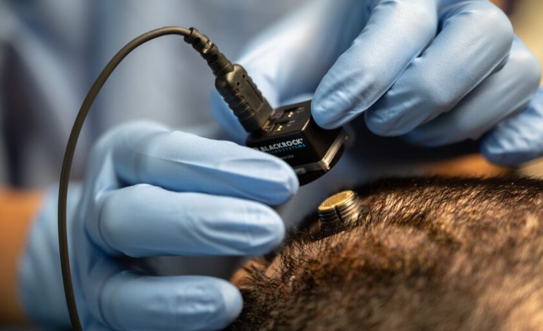 Tienen el primer implante cerebral listo para uso comercial

 – El diario andino